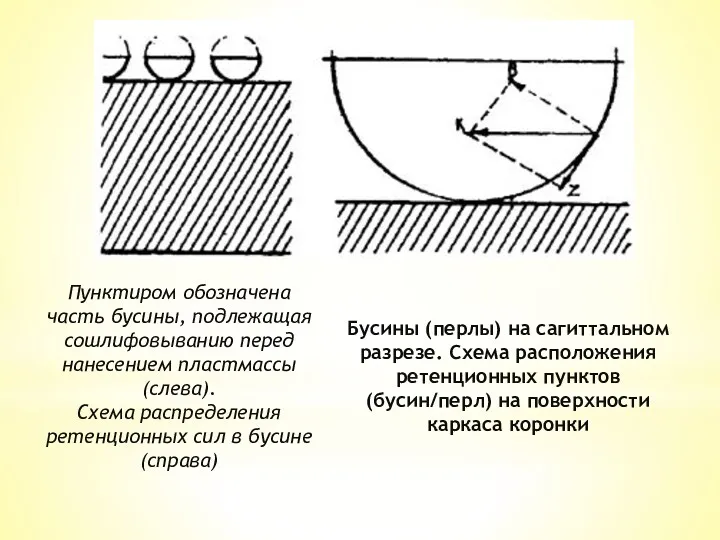 Бусины (перлы) на сагиттальном разрезе. Схема расположения ретенционных пунктов (бусин/перл)