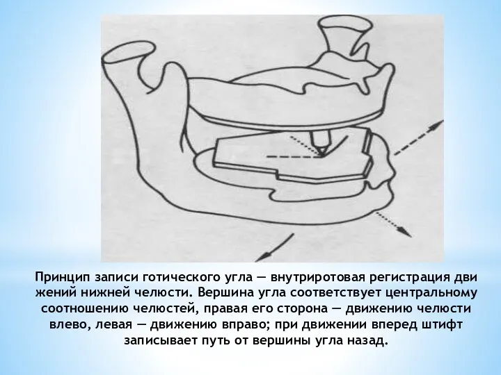 Принцип записи готического угла — внутриротовая регистрация дви­жений нижней челюсти.