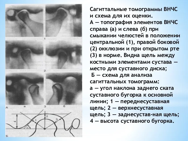 Сагиттальные томограммы ВНЧС и схема для их оценки. А —