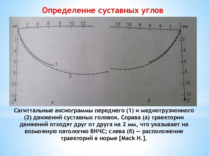 Определение суставных углов Сагиттальные аксиограммы переднего (1) и медиотрузионного (2)