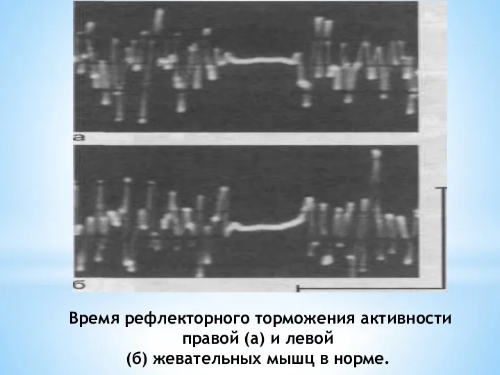 Время рефлекторного тормо­жения активности правой (а) и левой (б) жевательных мышц в норме.