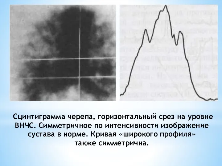 Сцинтиграмма черепа, гори­зонтальный срез на уровне ВНЧС. Симметричное по интенсивности