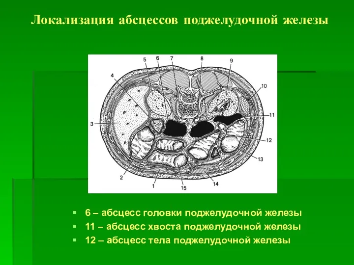 Локализация абсцессов поджелудочной железы 6 – абсцесс головки поджелудочной железы