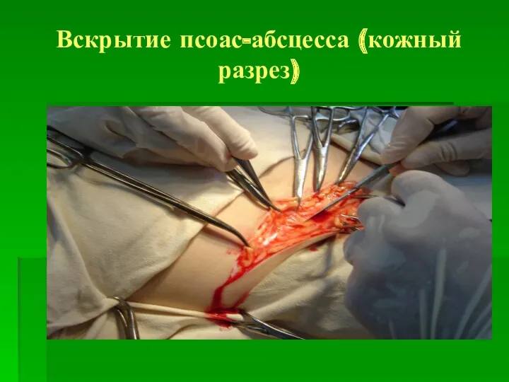 Вскрытие псоас-абсцесса (кожный разрез)