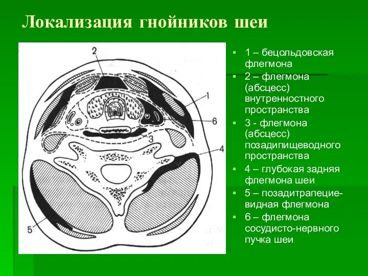 Локализация гнойников шеи 1 – бецольдовская флегмона 2 – флегмона