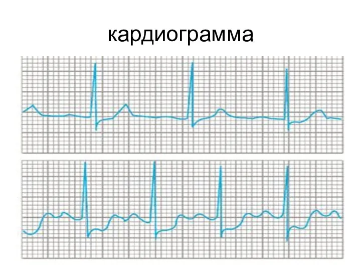 кардиограмма