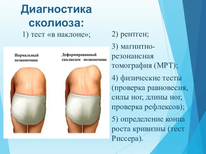 Диагностика сколиоза: 1) тест «в наклоне»; 2) рентген; 3) магнитно-резонансная