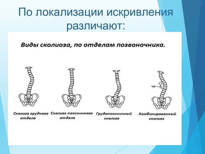 По локализации искривления различают: