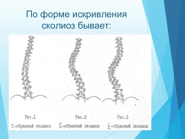 По форме искривления сколиоз бывает: