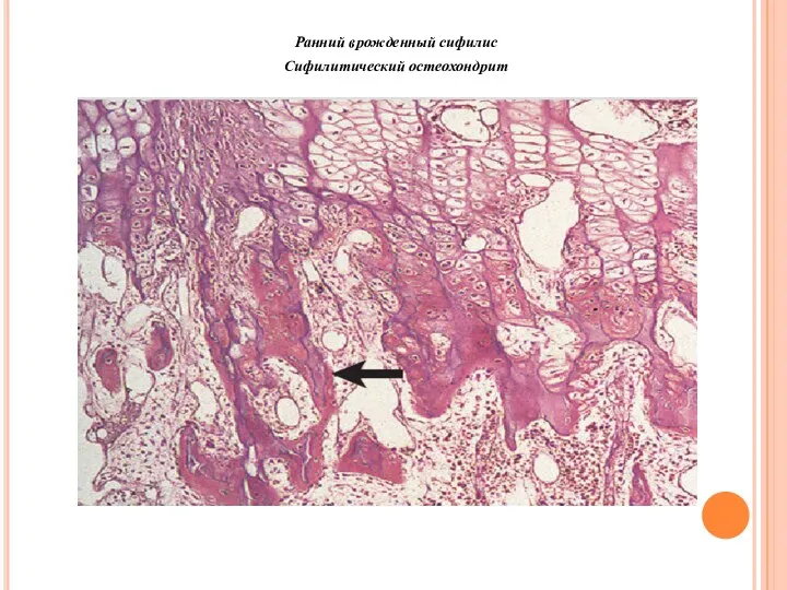 Ранний врожденный сифилис Сифилитический остеохондрит