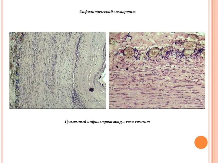 Сифилитический мезаортит Гуммозный инфильтрат вокруг vasa vasorum