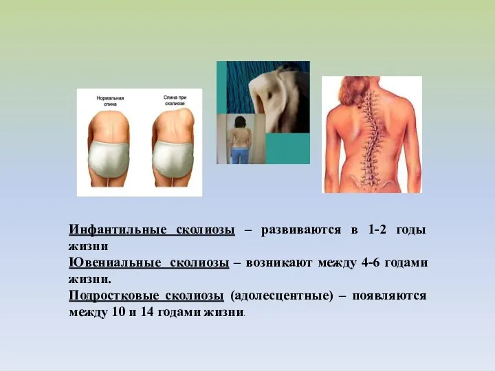 Инфантильные сколиозы – развиваются в 1-2 годы жизни Ювениальные сколиозы