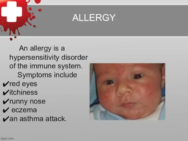 ALLERGY An allergy is a hypersensitivity disorder of the immune