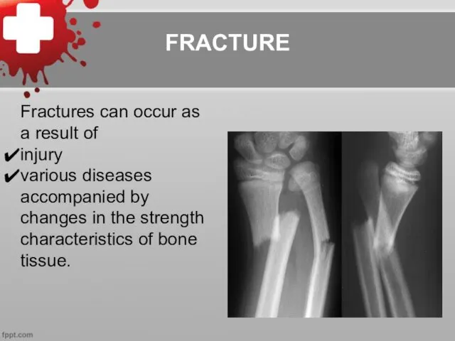 FRACTURE Fractures can occur as a result of injury various