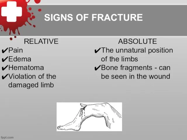 SIGNS OF FRACTURE RELATIVE Pain Edema Hematoma Violation of the