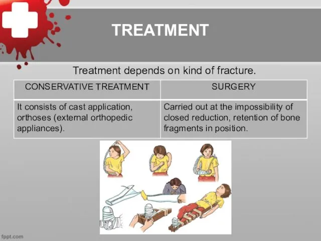 TREATMENT Treatment depends on kind of fracture.