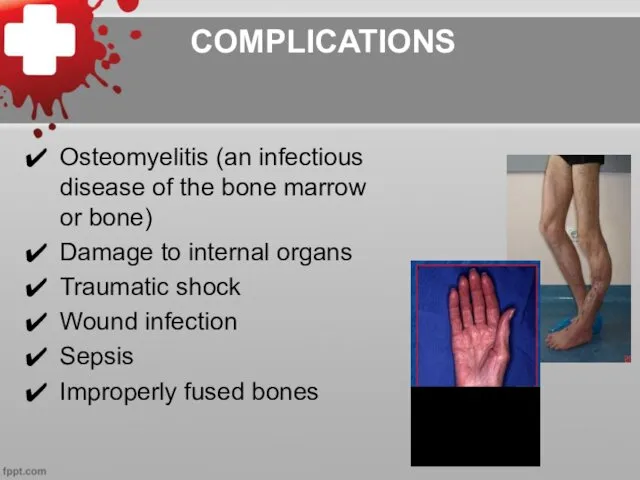 COMPLICATIONS Osteomyelitis (an infectious disease of the bone marrow or