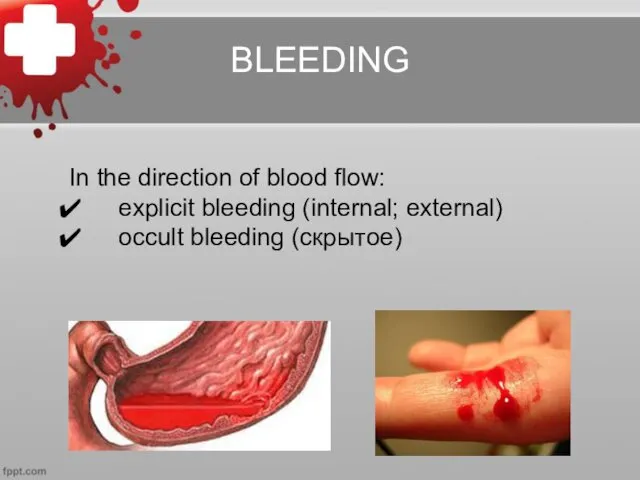 BLEEDING In the direction of blood flow: explicit bleeding (internal; external) occult bleeding (скрытое)