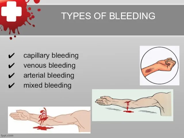 capillary bleeding venous bleeding arterial bleeding mixed bleeding TYPES OF BLEEDING