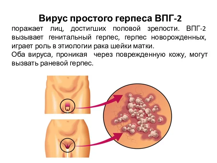 Вирус простого герпеса ВПГ-2 поражает лиц, достигших половой зрелости. ВПГ-2