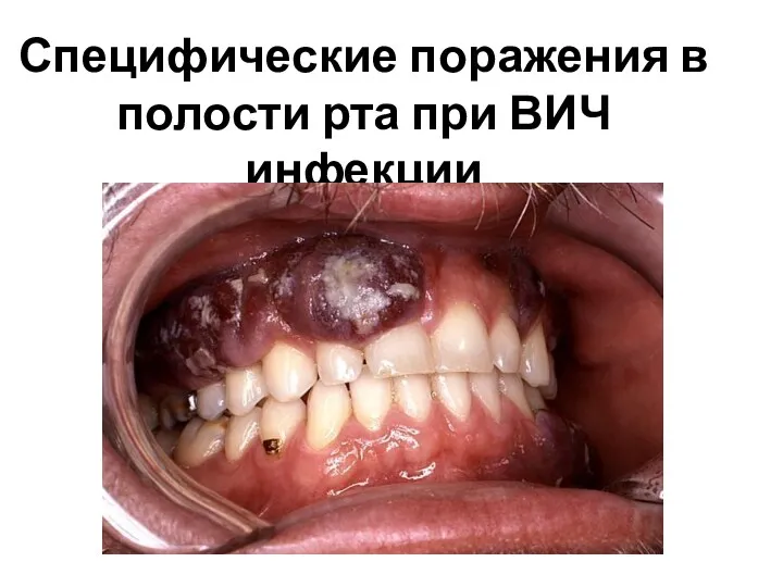 Специфические поражения в полости рта при ВИЧ инфекции