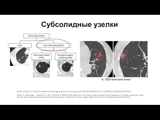 Субсолидные узелки Sakurai H, Asamura H. Sublobar resection for early-stage