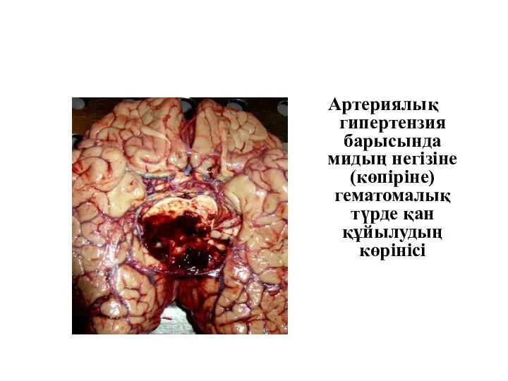 Артериялық гипертензия барысында мидың негізіне (көпіріне) гематомалық түрде қан құйылудың көрінісі