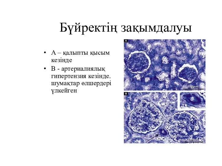 Бүйректің зақымдалуы А – қалыпты қысым кезінде В - артериалиялық гипертензия кезінде. шумақтар өлшердері үлкейген