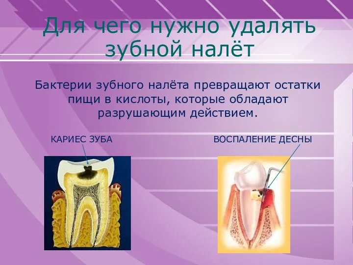 Для чего нужно удалять зубной налёт КАРИЕС ЗУБА Бактерии зубного