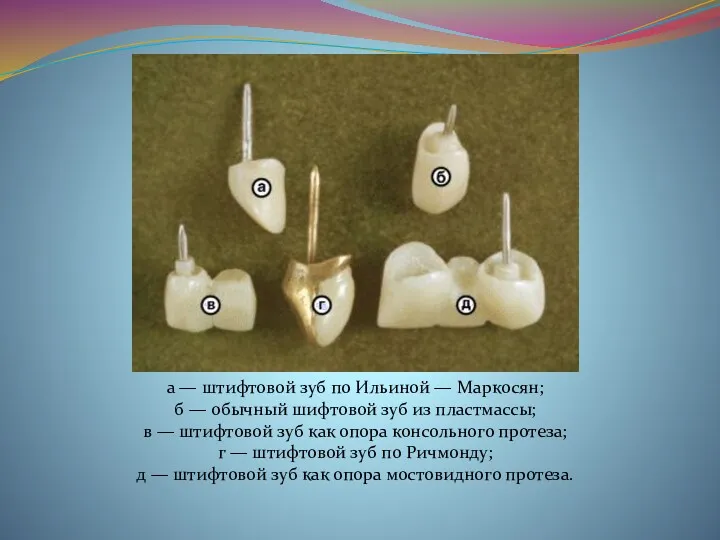 а — штифтовой зуб по Ильиной — Маркосян; б — обычный шифтовой зуб