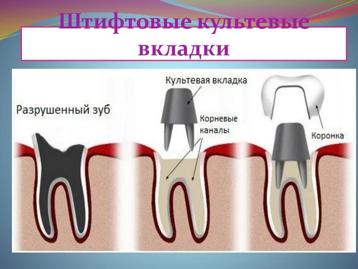 Штифтовые культевые вкладки