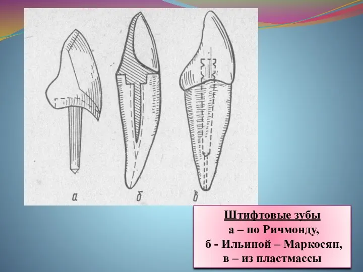 Штифтовые зубы а – по Ричмонду, б - Ильиной – Маркосян, в – из пластмассы