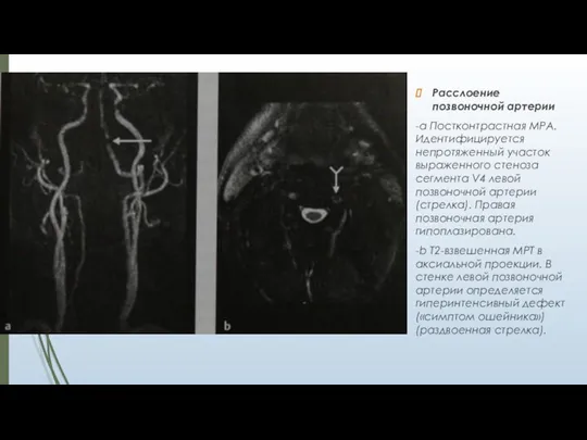Расслоение позвоночной артерии -а Постконтрастная МРА. Иденти­фицируется непротяженный участок выраженного стеноза сегмента V4
