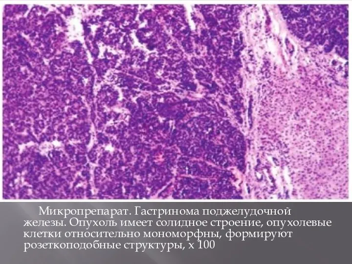 Микропрепарат. Гастринома поджелудочной железы. Опухоль имеет солидное строение, опухолевые клетки