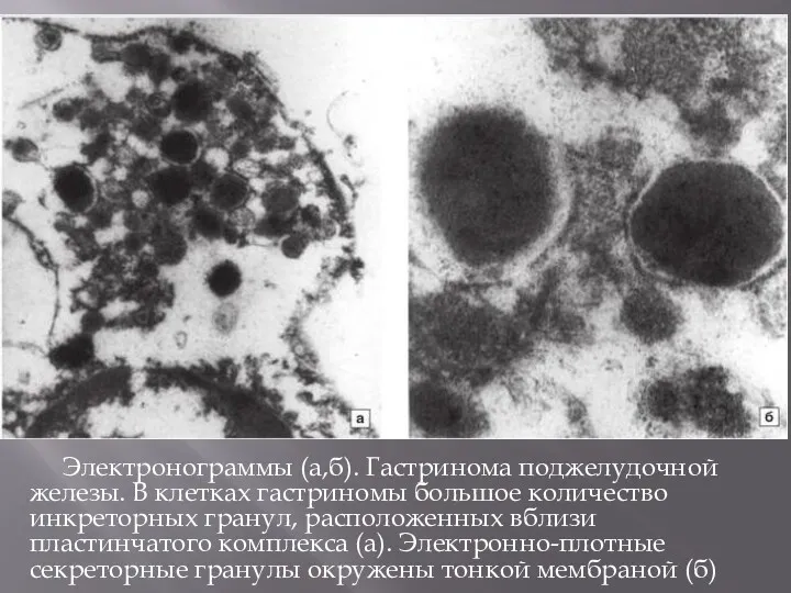 Электронограммы (а,б). Гастринома поджелудочной железы. В клетках гастриномы большое количество