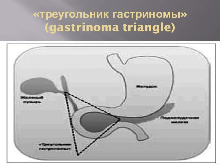 «треугольник гастриномы» (gastrinoma triangle)