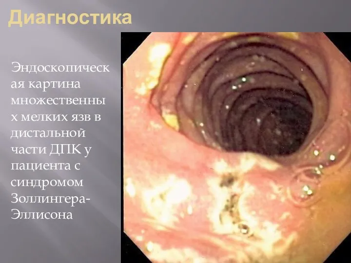 Диагностика Эндоскопическая картина множественных мелких язв в дистальной части ДПК у пациента с синдромом Золлингера-Эллисона