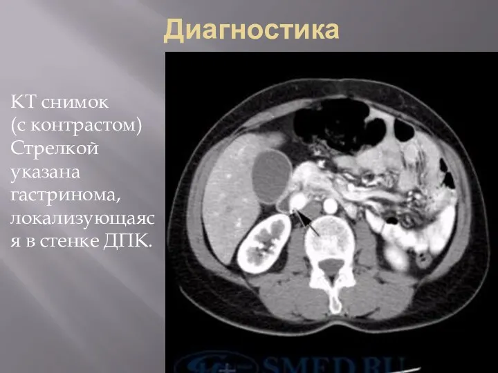 Диагностика КТ снимок (с контрастом) Стрелкой указана гастринома, локализующаяся в стенке ДПК.