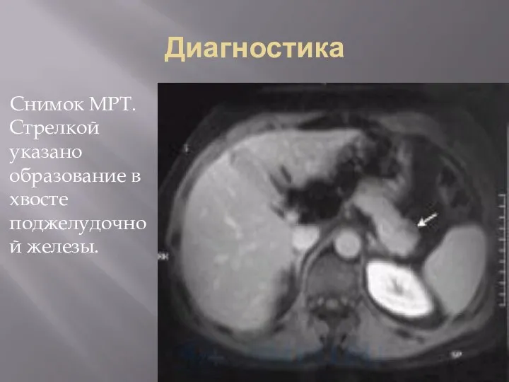 Диагностика Снимок МРТ. Стрелкой указано образование в хвосте поджелудочной железы.