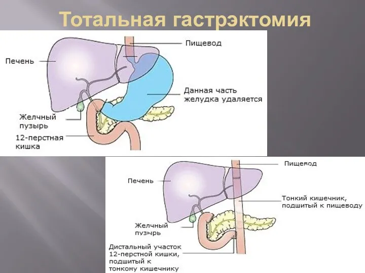 Тотальная гастрэктомия