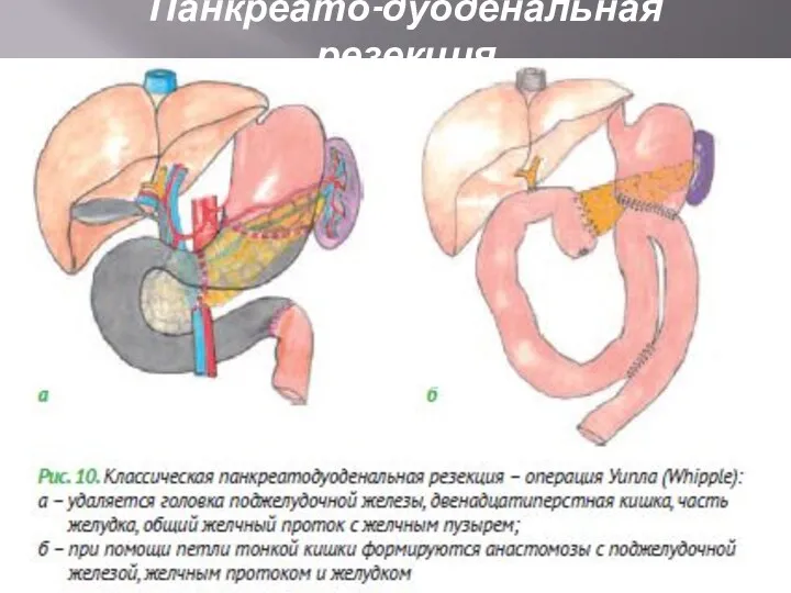 Панкреато-дуоденальная резекция