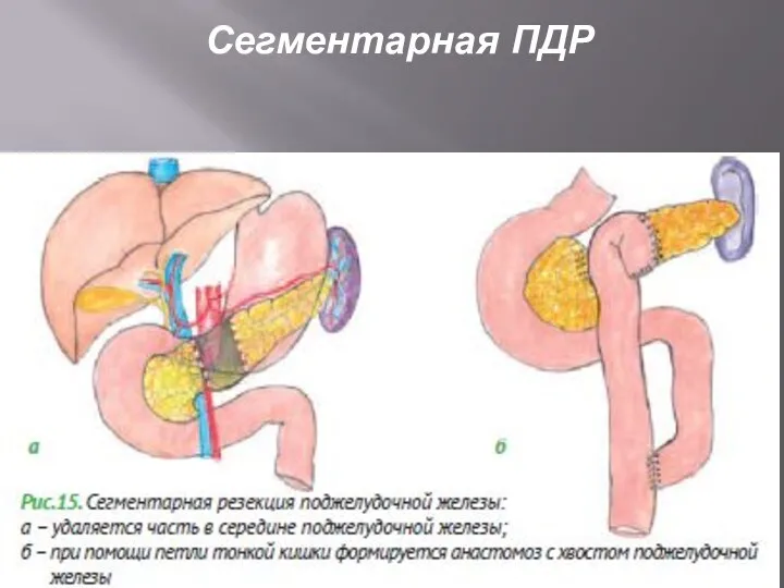 Сегментарная ПДР