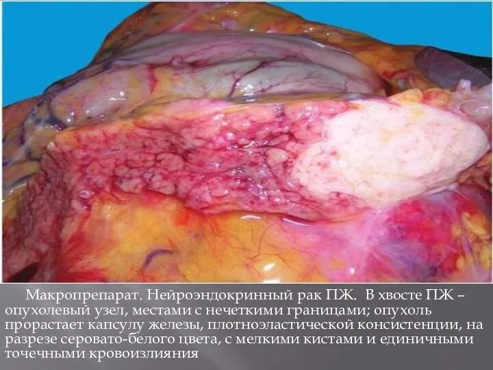 Макропрепарат. Нейроэндокринный рак ПЖ. В хвосте ПЖ – опухолевый узел,