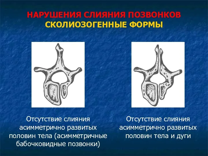 НАРУШЕНИЯ СЛИЯНИЯ ПОЗВОНКОВ СКОЛИОЗОГЕННЫЕ ФОРМЫ Отсутствие слияния асимметрично развитых половин