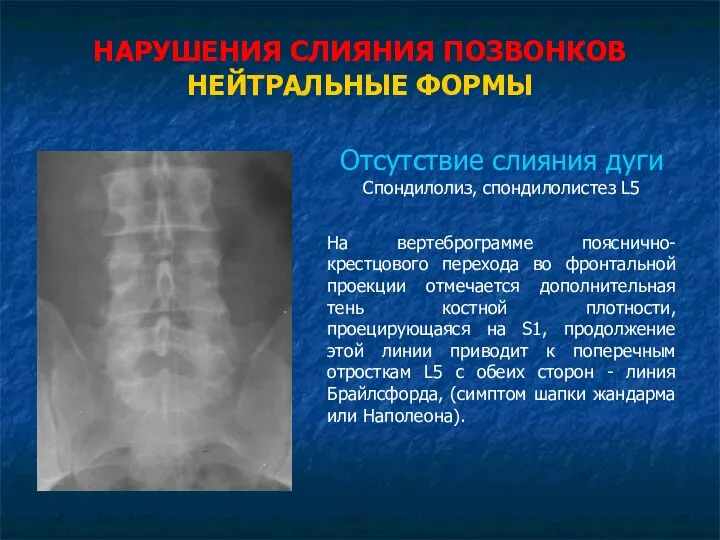 НАРУШЕНИЯ СЛИЯНИЯ ПОЗВОНКОВ НЕЙТРАЛЬНЫЕ ФОРМЫ Отсутствие слияния дуги Спондилолиз, спондилолистез