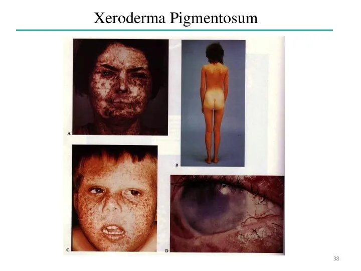 Xeroderma Pigmentosum