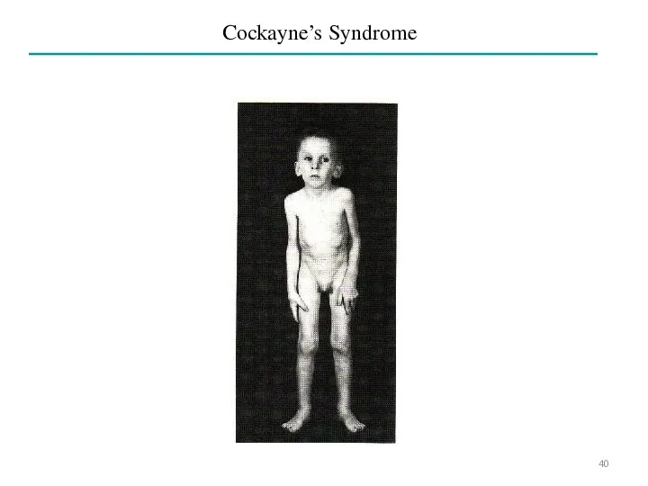 Cockayne’s Syndrome