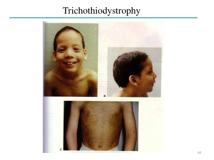 Trichothiodystrophy