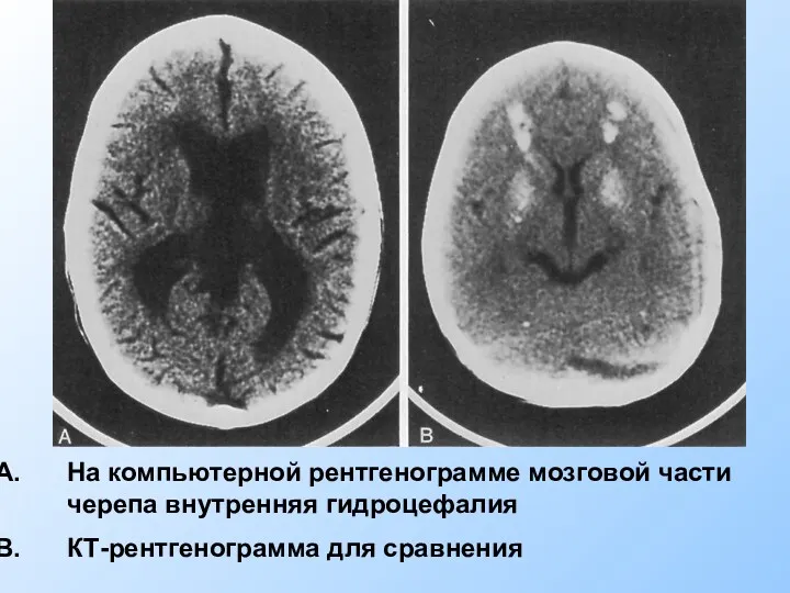На компьютерной рентгенограмме мозговой части черепа внутренняя гидроцефалия КТ-рентгенограмма для сравнения