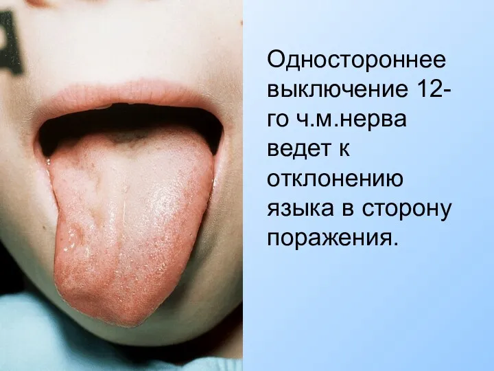 Одностороннее выключение 12-го ч.м.нерва ведет к отклонению языка в сторону поражения.